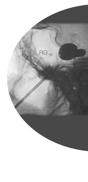 Microcompressão Percutânea com Balão
